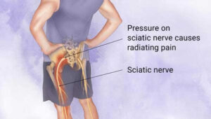 Read more about the article Sciatic Nerve Pain: Causes, Symptoms,and Chiropractic Care