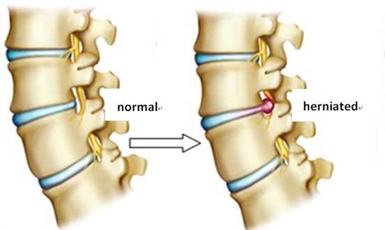 Read more about the article “Herniated disc”, they say?