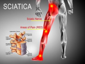 Read more about the article EXERCISE, LIFESTYLE, AND CHIROPRACTIC CARE FOR SCIATICA