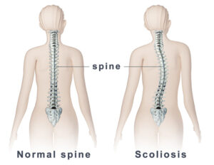 Read more about the article That S word! What is scoliosis?