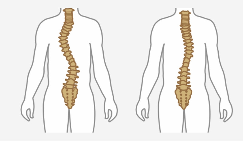 You are currently viewing How to Fix Scoliosis: Can Chiropractic Care Help?